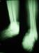 Feet  X-Ray of a leper